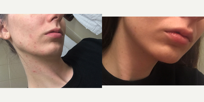 18-24 year old woman treated with Microdermabrasion - This is a before and after side view of a patient who has struggled with acne her entire life. She had 3 microdermabrasions and our aesthetician created a skincare regime for her to follow.