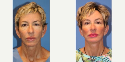55-64 year old woman treated with Eyelid Surgery, Facelift, Neck Lift, Brow Lift, Earlobe Repair, CO2 Laser - This is a 55 year old female presenting with signs of facial ageing. She has face and neck skin laxity and droop, early jowling, facial wrinkles, upper eyelid skin laxity or dermatochalasis, brow ptosis and ear lobe enlargement. She underwent a facelift, necklift, blepharoplasty upper/lower eyelids, brow lift, ear lobe reduction and perioral CO2 laser. Before and 8 week post op result.Recovery from a facelift varies depending on the type of procedure, individual healing, and post-operative care. Heres a general timeline:First Week:	Days 1-2: Swelling, bruising, and discomfort are most intense. Pain medication may be needed. A compression bandage is usually worn.	Days 3-7: Bruising and swelling peak around days 3-4 and then begin to subside. Stitches may be removed around day 5-7. Light activities can resume.Week 2:	Swelling and bruising improve significantly.	Numbness, tightness, and mild discomfort persist.	Many people feel comfortable going out in public with makeup.Weeks 3-4:	Most visible swelling and bruising have faded.	Patients can resume moderate exercise.	Incision lines begin to soften but are still noticeable.Months 2-3:	Results look more natural as swelling resolves.	Numbness and tightness continue to improve.	Scars start fading but may take up to a year to fully mature.Full Recovery:	Most patients see their final results around 3-6 months post-surgery.	Protecting skin from the sun and maintaining a healthy lifestyle can enhance results.