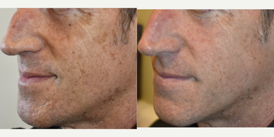 Los Angeles Age spot removal for men, IPL near me. - If you're concerned about age spots, freckles or general discoloration, call us today to learn about laser treatments. Winter is the perfect time to address sun damage concerns.