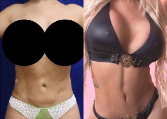 Woman treated with Liposuction Revision - Woman treated with Liposuction Revision