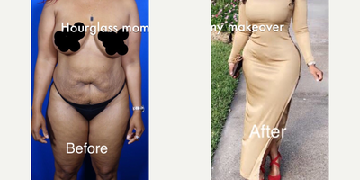Mommy Makeover - She underwent an hourglass mommy makeover in order to restore her pre-baby body. As you can see her body tremendously improve a lot after undergoing this combined procedure.