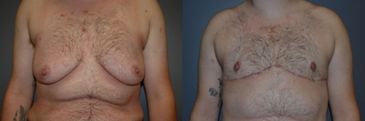 FTM Transgender  - Transgender female to male. Bilateral mastectomies and free nipple grafts. Four month photo. Immature, (fading), scars.