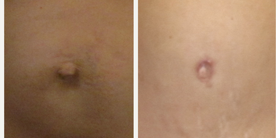 Belly Button Surgery for this 40 Year Old Woman - This 40 year old woman had belly button surgery with correction of muscle separation and umbilical hernia repair with umbilicoplasty.