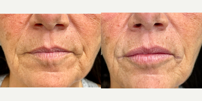 55-64 year old woman treated with Lip Fillers (Cannula technique) - This patient had hyaluronic acid dermal filler (Restylane Kysse) to the upper and lower lips - 1 syringe so far - via Cannula technique entering from the outer corners (note the light marks and slight swelling there from local anesthetic and cannula entry which resolves by the next day) and injecting into the substance of the lips. Minimal swelling and no bruising are the hallmark of the cannula technique for this procedure. Note the symmetric and natural appearing improvement which can be enhanced further by additional filler depending upon the patient's goals for volume and appearance.