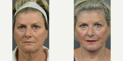 Woman treated with ActiveFX - DEEP PLANE FACE & NECK LIFT with ACTIVE FX LASER RESURFACING. Dr. James Marotta see this patient back in office for her 6 month + post op visit. Check out that neck line and glowing skin! Beautiful, natural results worth sharing.