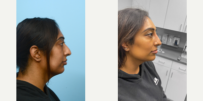 25-34 year old woman treated with Nonsurgical Nose Job - By strategically placing filler, Dr. Wise was able to both mask this patient's dorsal hump and lift the nasal tip.
