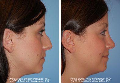 Rhinoplasty - Rhinoplasty