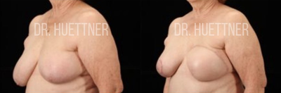 Woman treated with Breast Reconstruction with TRAM Flap - Woman treated with Breast Reconstruction with TRAM Flap after diagnosed with recurrence of left sided breast cancer requiring the removal of her left breast tissue. Having undergone radiation treatment in the past she required breast reconstruction using her own tissue from the abdomen (TRAM flap). She chose to have her right breast lifted for symmetry (mastopexy), but not to have her left nipple reconstructed.