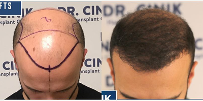 Man treated with Hair Loss Treatment - Man treated with Hair Loss Treatment. After 10 months