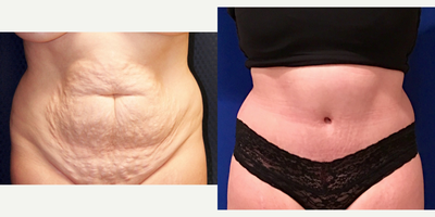 25-34 year old woman treated with Tummy Tuck - 2 kids
5'2 height
125lbs