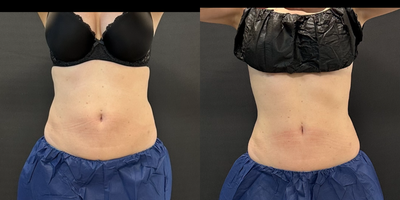 35-44 year old woman treated with CoolSculpting, CoolSculpting Elite - CoolSculpting results on Flanks Love Handles