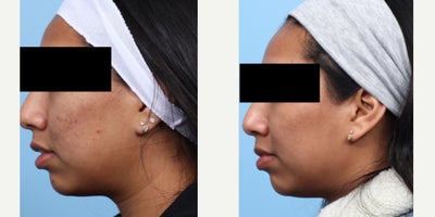 18-24 year old woman treated with SkinPen - After 2 sessions of SkinPen microneedling, this patient is on their way to smoother, clearer skin, with a noticeable reduction in acne scars. Her results are shown after 1 month after her second session. She is getting one more session and will have more improvement.