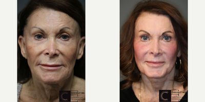 PRP Injections - Laser resurfacing with PRP.
