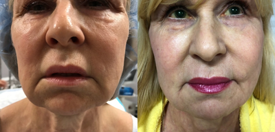 65-74 year old woman treated with Thread Lift - Medithreads before and 2 months after PDO thread lift to jowls.