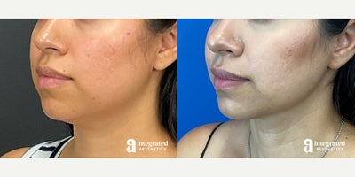 35-44 year old woman treated with AccuTite - The patient is a 38-year-old female who had concerns with the appearance of her lower face and neck. Dr. Cho performed accutite to the lower face and neck. After photos are 1 year post procedure.