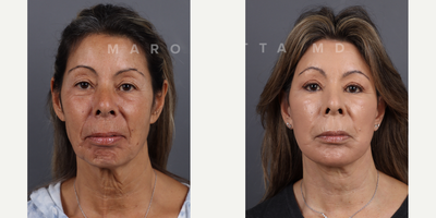 Woman treated with Dermabrasion, Chemical Peel - Facial rejuvenation with Dr James Marotta. Before and after journey. Dr. Marotta's expertise shines through in these great results, achieved through a combination of deep plane face and neck lift, upper blepharoplasty, perioral dermabrasion, and a chemical peel. Deep Plane Face and Neck Lift: Elevate your beauty to new heights as Dr. Marotta reshapes and rejuvenates facial contours by addressing deeper layers, tackling sagging skin and restoring youthful volume. Upper Blepharoplasty: Open your eyes to a brighter, more refreshed look! Dr. Marotta's precise upper blepharoplasty technique removes excess skin, revealing the true beauty of your gaze. Perioral Dermabrasion: Erase the traces of time around your mouth with perioral dermabrasion. Experience smoother, radiant skin as fine lines and wrinkles fade away. Chemical Peel Magic: Peel back the years with a chemical peel curated by Dr. Marotta. Unveil a radiant complexion, free from imperfections, as the outer layers of your skin are renewed.