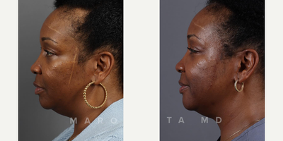 Woman treated with Scar Removal - Geometric broken line closure, sculpted to refine a scar on our patients cheek. Precise incisions, meticulous tissue alignment, and fine sutures converge in a personalized transformation. Swipe left to witness the powerful before-and-after.