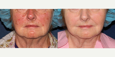 55-64 year old woman treated with Fraxel Laser - Woman with severe age spots and unwanted pigmentation on the face is treated with the Fraxel laser.