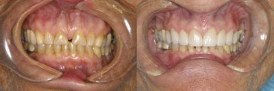 Diastema (Gap) Closure - This lovely older woman had always disliked her gap in her front teeth and finally decided it was time to get it fixed.&nbsp; Simply veneering the 2 front teeth would make them look &quot;fat&quot; so by doing 8, the proportions could look more balanced and natural, and also allowed her to change the color to a lighter shade.