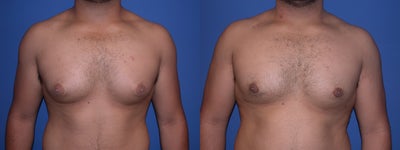Before and After Male Breast Surgery - This young man was interested in a more sculpted appearance of his chest to be more in balance with the rest of his body.  I used a combination of ultrasound, liposculpture, and direct excision of breast tissue to sculpt and shape his chest, giving him a more masculine contour to his torso.