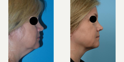 Woman treated with PrecisionTx - Woman treated with PrecisionTx