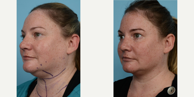 Woman treated with PrecisionTx - Woman treated with PrecisionTx
