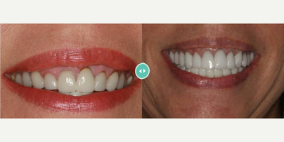 Woman treated with Porcelain Veneers - Woman treated with Porcelain Veneers