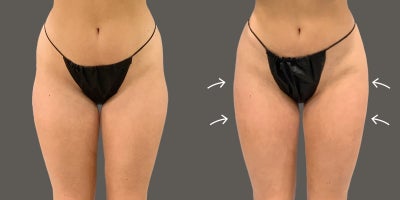35-44 year old woman treated with AirSculpt - Patient received Stomach and outer thigh AirSculpt fat removal. She then had the fat transferred to her hips to fill her hip dips. This procedure is called HipFlip. Results showing here are 6 month post-op.
