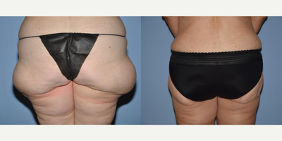 55-64 year old woman treated with Butt Lift - This 59 year old patient came to see Dr. Romanelli after losing over 70lbs. She was left with excess skin of her lateral thighs. The patient is shown 9 months post op and is thrilled with the results of her procedure.