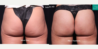 45-54 year old woman treated with Qwo - Qwo injections used to treat cellulite on the buttocks of a female patient by Dr. Fabi.