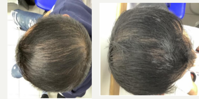 45-54 year old man treated with PRP for Hair Loss, Nutrafol - 3 month combination therapy prp + nutrafol, + minoxdil
