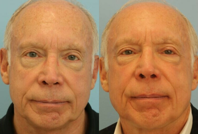 Full Face Photofractional (IPL + Resurfx) - Full Face Photofractional (IPL + Resurfx)