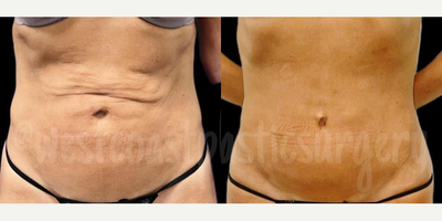 Woman treated with BodyTite - This patient had a skin tightening treatment with radiofrequency under the skin with BodyTite. She achieved a great improvement in her skin laxity without scars.