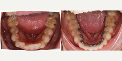 25-34 year old woman treated with InBrace - InBrace Lingual braces