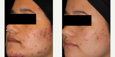 Woman treated with AviClear - Woman treated with AviClear