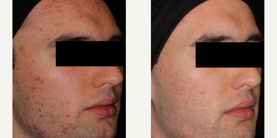 Man treated with AviClear - Man treated with AviClear