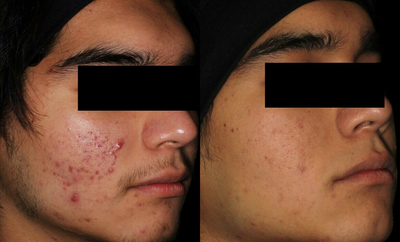 Man treated with AviClear - Man treated with AviClear