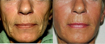 Sculptra Treatment - 
	Treated a patient with Sculptra in order to restore volume to her face.
