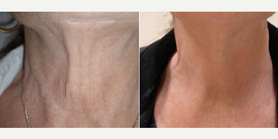 Woman treated with Intracel - Woman treated with Intracel