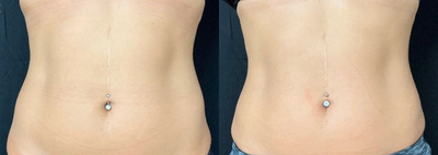 Woman treated with CoolTone - Woman treated with CoolTone for more defined abs