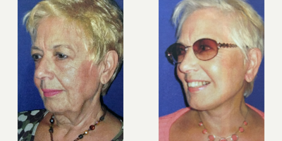 65-74 year old woman treated with Facelift and Neck Lift - When this patient came to see me for a consultation, her energy and passion for life wereimmediately apparent. She is a woman who not only wanted her appearance to match how she felt on the inside, but also for it to radiate. I created a treatment plan for her which involved a SMAS facelift, neck lift (platysmaplasty), and conservative lipo-sculpting.