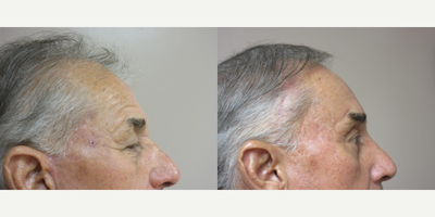 Upper Eyelid Surgery - Patient felt his heavy eyelids made him look older and tired.  Dr. Eric Schaffer performed an upper eyelid blepharoplasty which give him a much improved appearance.