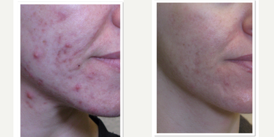 25-34 year old woman treated with Laser Genesis - Patient treated with Laser Genesis for acne and scarring. Results: better tone, improved texture, tighter skin, reduce wrinkles, reduce acne scars, and diminish pore size. Recommended treatments - 4 - 6 for best results.