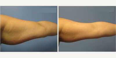Woman treated with CoolSculpting - Woman treated with CoolSculpting.