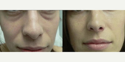 Woman treated with Dermal Fillers - Woman treated with Dermal Fillers