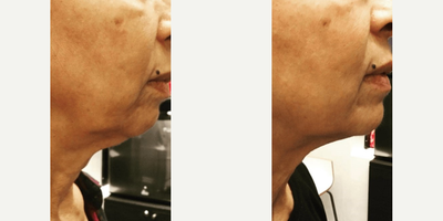 Woman treated with Kybella - Woman treated with Kybella