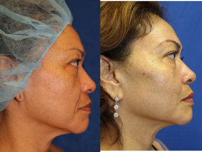 Fat Transfer to Face (side view R) - Patient wanted higher cheekbones. She did not want silicone cheek implants. Fat was transferred from her abdomen to her cheekbone. The transferred fat changed the shape of her face from an elongated rectangular to a more attractive, inverted triangle.