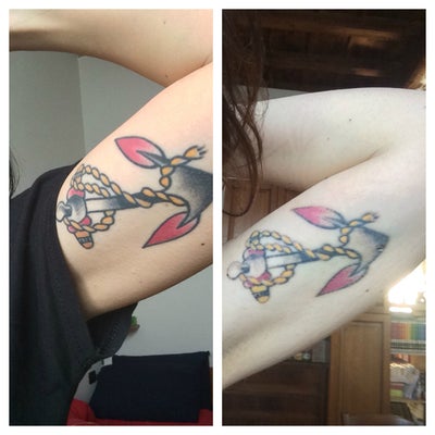 Which is better to remove my tatto: Laser Q Switch Revlite 