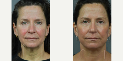 Woman treated with Facelift - Woman treated with Facelift