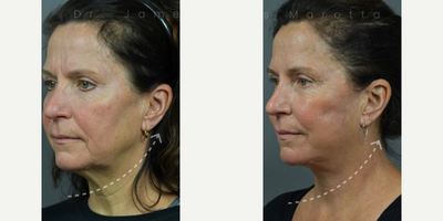 Woman treated with Facelift - Woman treated with Facelift